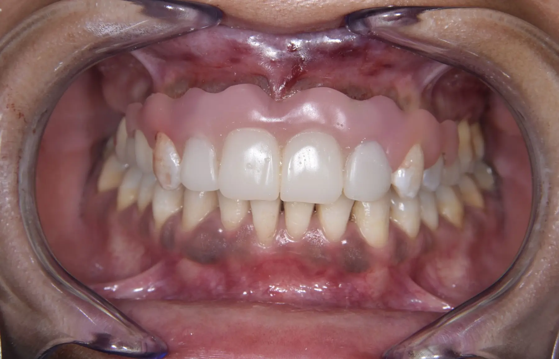 Prothèse TCS ® usinée